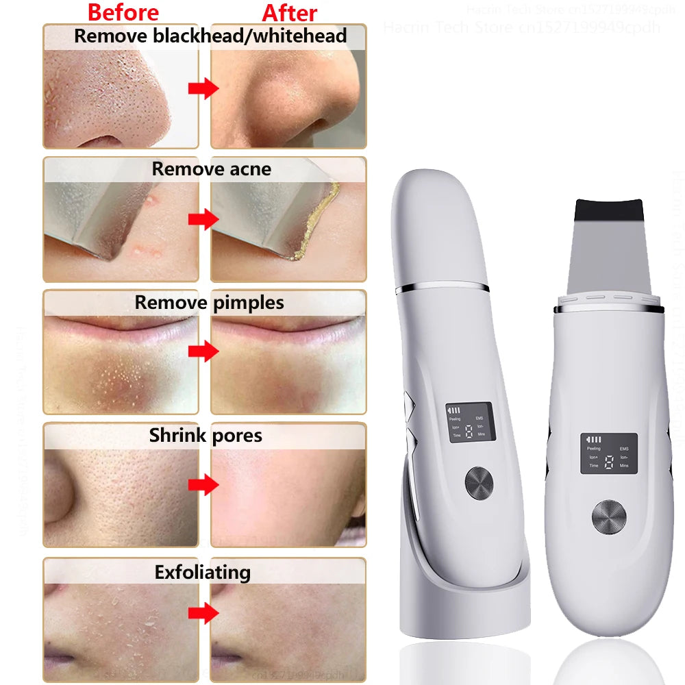 GlowSonic™ Ultrasonic Facial Scrubber